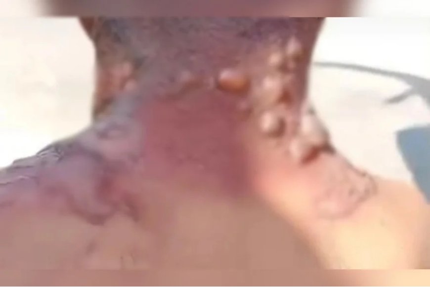 IMAGENS FORTES!! Homem acusa namorada de mantê-lo em cárcere e queimá-lo com água fervente