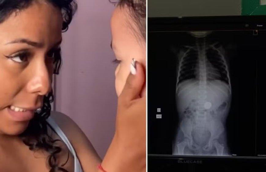 Mãe se choca após filha revelar o que engoliu, e raio-X confirma