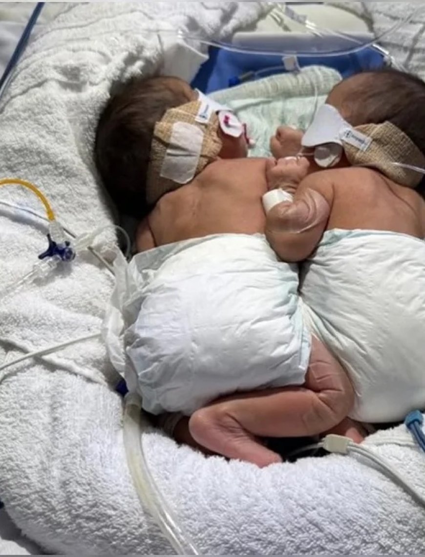 Nascidos unidos pelo abdômen, gêmeos siameses morrem em Goiânia