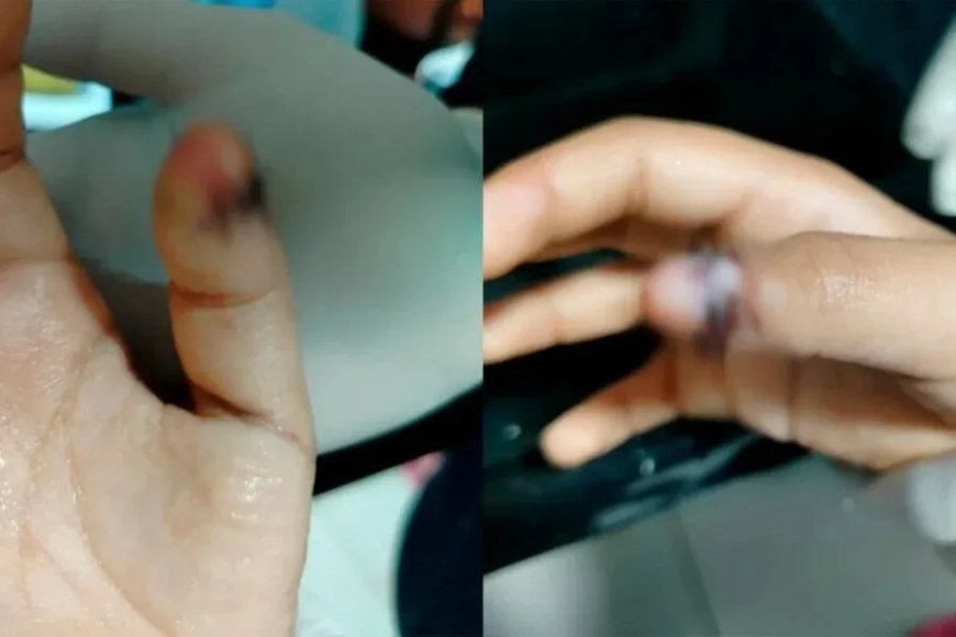 Menino autista tem dedo esmagado na porta da escola e família denuncia
