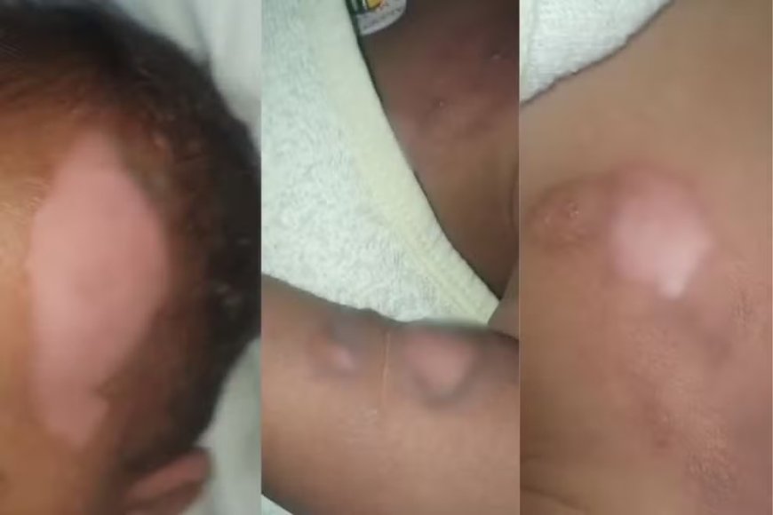 Bebê de 9 meses sofre queimaduras graves durante banho em creche e vai para cirurgia