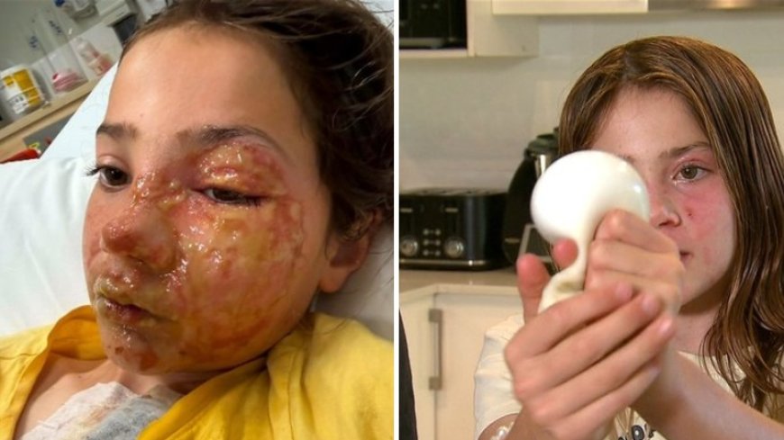 Desafio viral termina em tragédia: Squishy aquecido explode e desfigura criança de 10 anos