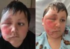 Alerta: brinquedo viral explode e deixa crianças com queimaduras graves