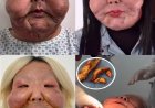 Médico mostra antes e depois de Juju do Pix após seis meses de cirurgia para retirada de óleo mineral; veja