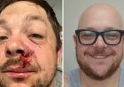O homem mais azarado? Sobrevive a raio um ano depois de quase morrer com rojão