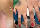 Mulher sofre queimaduras após companheiro se irritar com unhas pintadas de vermelho
