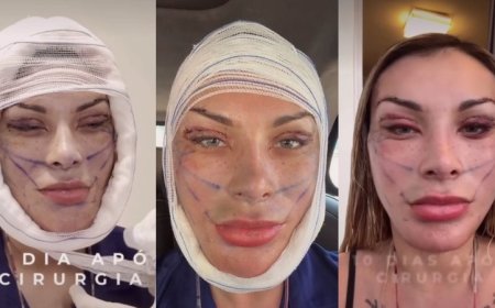 Andressa Urach exibe resultado de 50ª cirurgia plástica e diz ter "rejuvenescido 15 anos"