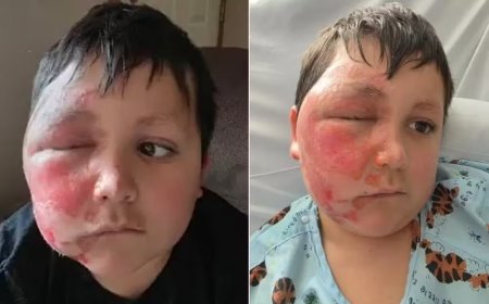 Alerta: brinquedo viral explode e deixa crianças com queimaduras graves