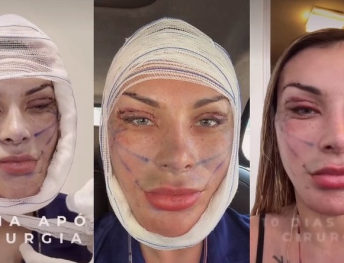 Andressa Urach exibe resultado de 50ª cirurgia plástica e diz ter "rejuvenescido 15 anos"