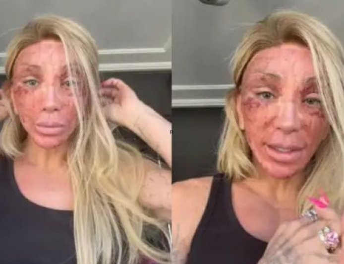 Maya Massafera surge com o rosto irreconhecível após procedimento estético e assusta seguidores