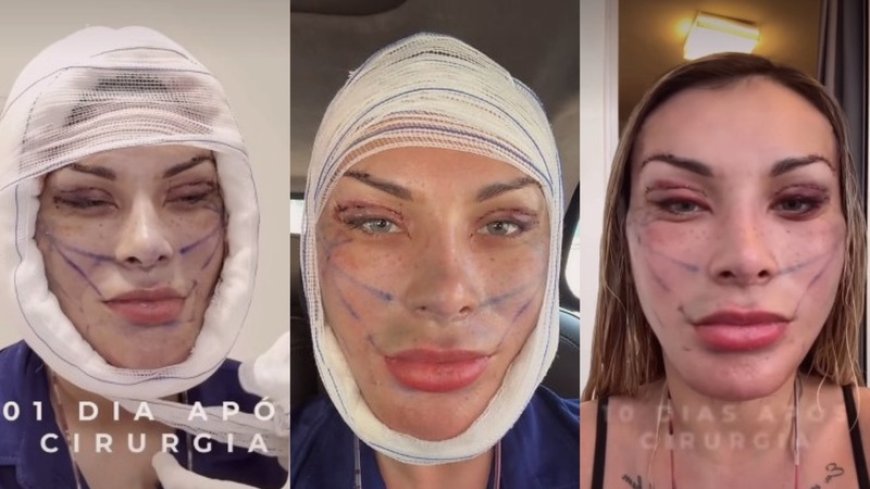 Andressa Urach exibe resultado de 50ª cirurgia plástica e diz ter "rejuvenescido 15 anos"
