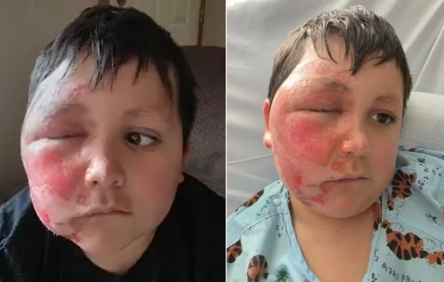 Alerta: brinquedo viral explode e deixa crianças com queimaduras graves