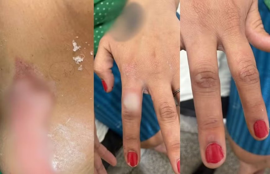 Mulher sofre queimaduras após companheiro se irritar com unhas pintadas de vermelho