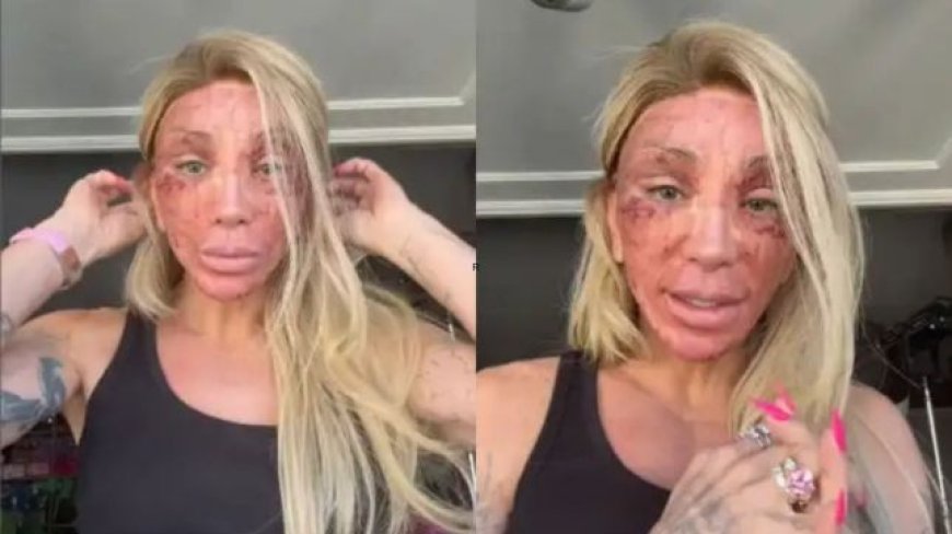 Maya Massafera surge com o rosto irreconhecível após procedimento estético e assusta seguidores